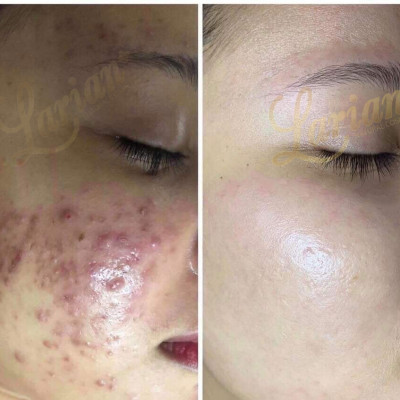 Combo 5 lọ Tế bào gốc Acne Ampoule Larian (làm giảm mụn sưng viêm, làm đầy sẹo rỗ, xoá mờ vết thâm)