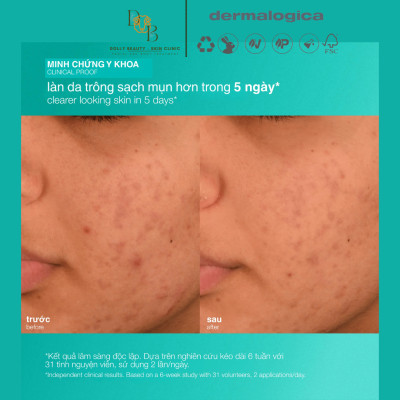 Dưỡng ẩm dành riêng cho da mụn ACNE BIOTIC MOISTURIZER giúp ngăn ngừa mụn tái phát của Dermalogica