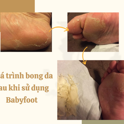 MẶT NẠ Ủ CHÂN BABY FOOT CHO DA GÓT CHÂN KHÔ VÀ NỨT NẺ NHẬT BẢN