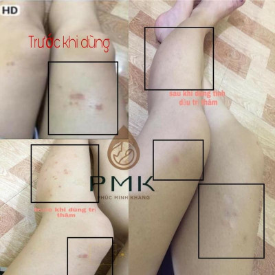 Tinh Chất Serum Mờ Thâm Minh Khang - Hết mọi loại thâm, an toàn, lành tính sử dụng mọi lứa tuổi